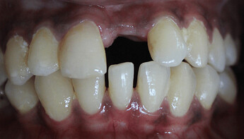 narrow edentulous space