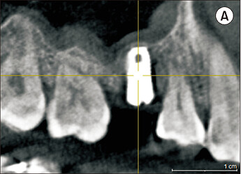 Six months post-operative cone-beam