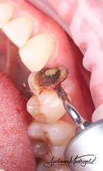 WH Piezo used for atraumatic extraction
