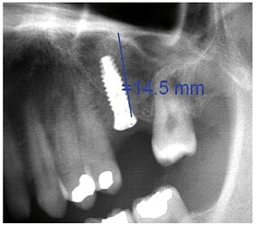 Postoperative panoramic X-ray view.