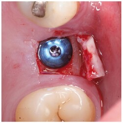 Implant positioned in the same surgical step.