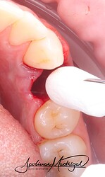 Placement of OsteoGen® Plug