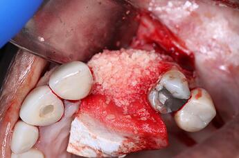 Osseoseal tucked under the flap