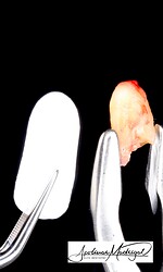 Extracted tooth (extraoral view)