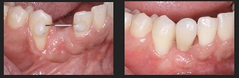 comparison of preop and post op