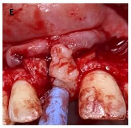 Flipping the flap from the palatal mucosa.