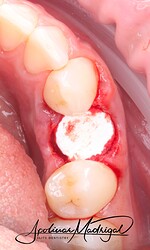 OsteoGen® Plug in socket
