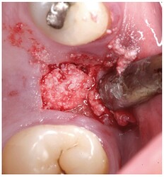 Particulate bone graft placement.