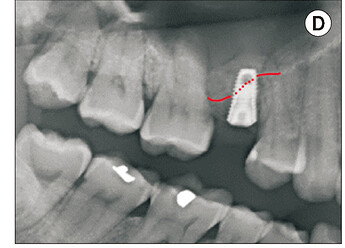 Immediate post-operative radiograph