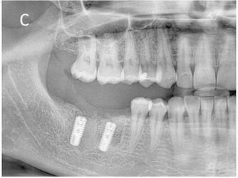 Postoperative 5th month panoramic radiograph image.