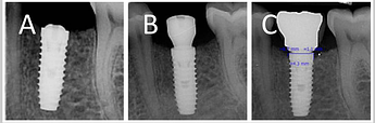 crestal implant