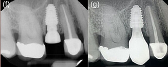 Peri‐apical radiograph