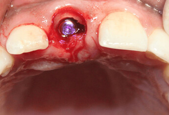 osteotomy