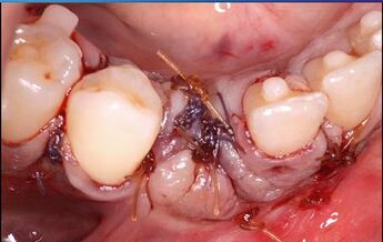 primary closure using the periosteal releasing incisions and tension-relieving sutures sutures