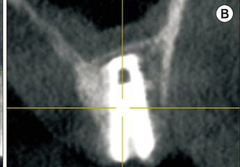 he apex of the implant is completely surrounded by bone