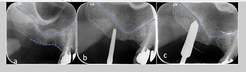 a –c Showing sloping sinus floor and sequence of drilling using the Densah burs