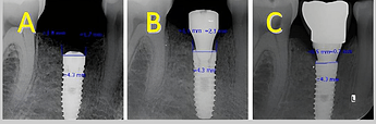Subcrestal implant