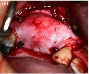conventional flap closure