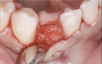 surgical uncovery of implant reveals bone around area