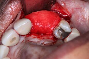 extending the membrane onto the native margins