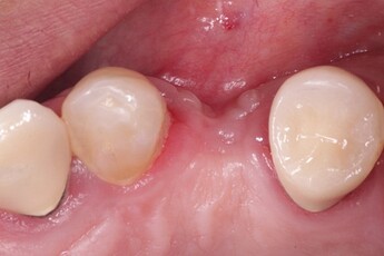 site 12 presented with a significant buccal contour defect