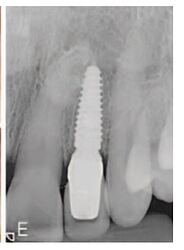 periapical final restoration