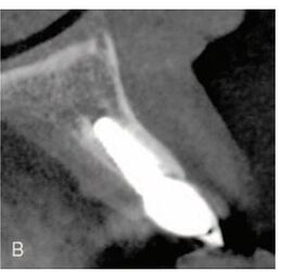 followup CBCT scan