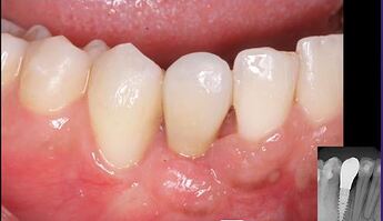 screw retained crown