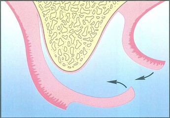 d. The connective tissue pedicle is reflected toward the buccal aspect