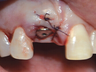 healing Abutment placed and site sutured