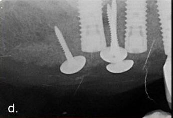 radiograph demonstrating the augmented volume