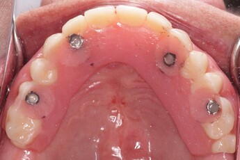 fixed screw retained prosthesis
