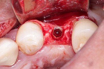 implant placed
