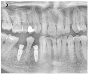 Placement of the implant after tooth extraction and curettage of the socket.