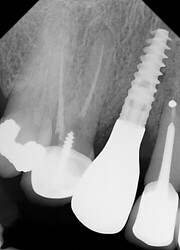 implant was restored with a screw-retained crown