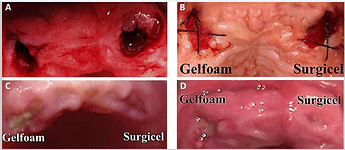 gelfoam-vs-surgical