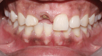 Preoperative intra-oral image showing fractured 11