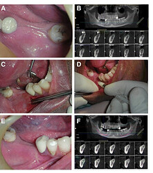 Lateral alveolar ridge augmentation