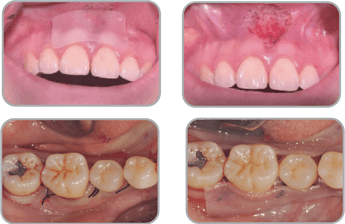 Periodontal Flap Operation