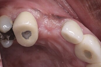 buccal ridge deficiency persisted