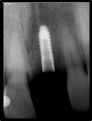 bone condensation