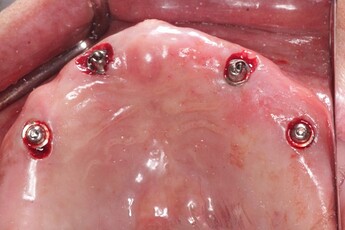 straight and angled multi-unit abutments