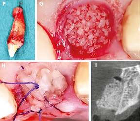Alveolar ridge preservation.