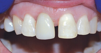 BruxZir® Esthetic restoration delivered