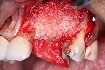 DALI Cortical cancellous bone