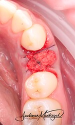 Sutured in “x” formation completed.