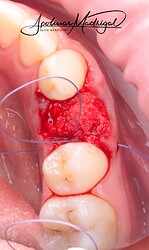 OsteoGen Plug sutured in place
