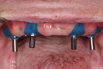 connection of parallel temporary copings