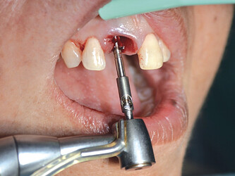 pilot drill was used to begin the osteotomy