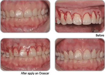 Crown lengthening procedure: CLP1